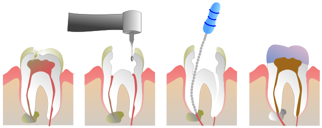 endodontia